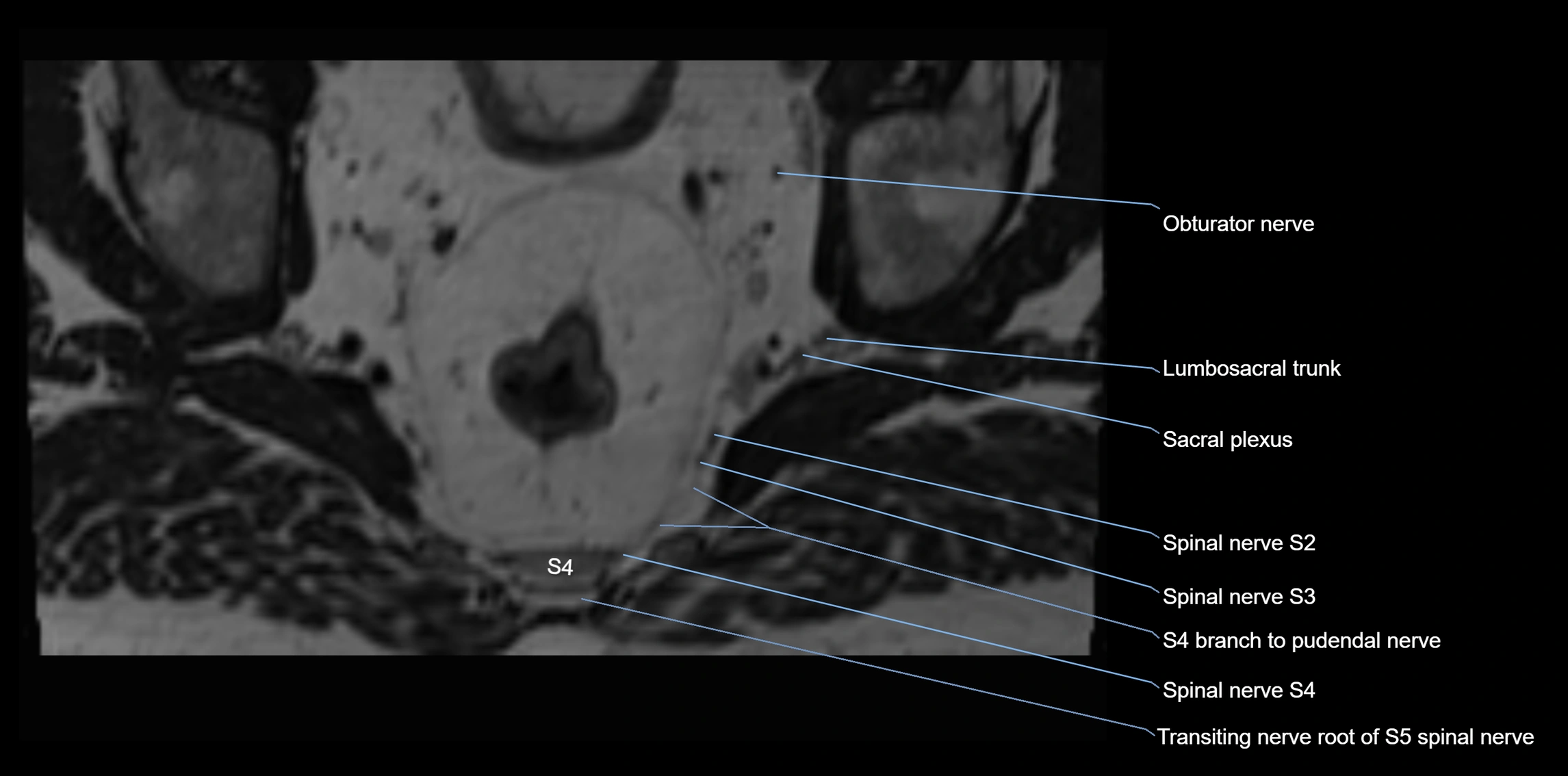 MR lumbosacral plexus axial cross sectional anatomy 3T  radiology  image-img-1008001-00105.webp
